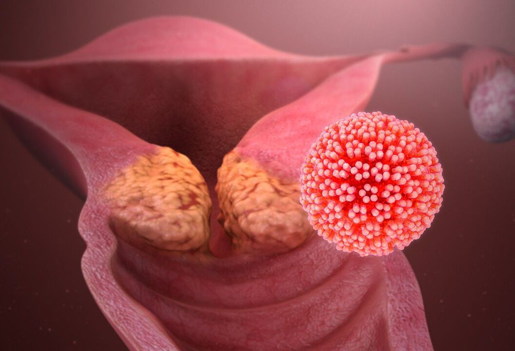 A méhnyak HPV-elváltozása