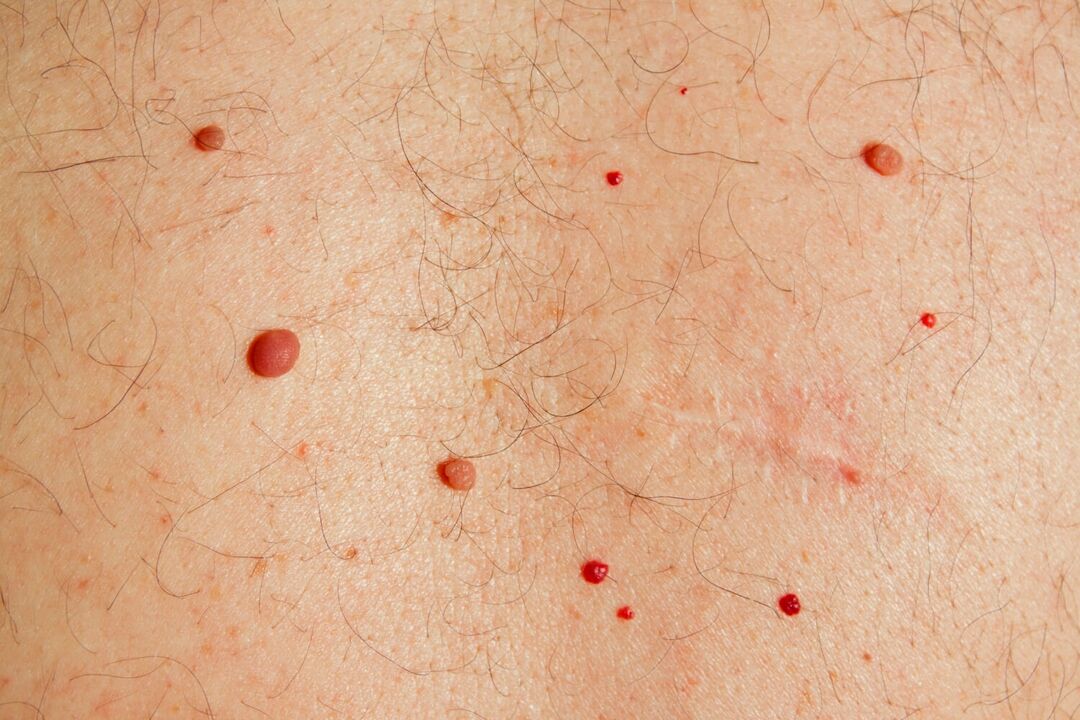 A HPV által okozott papillómák a testen